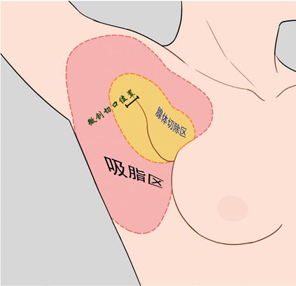 图解小切口联合脂肪抽吸术_副乳_副乳治疗方式 - 好大夫在线