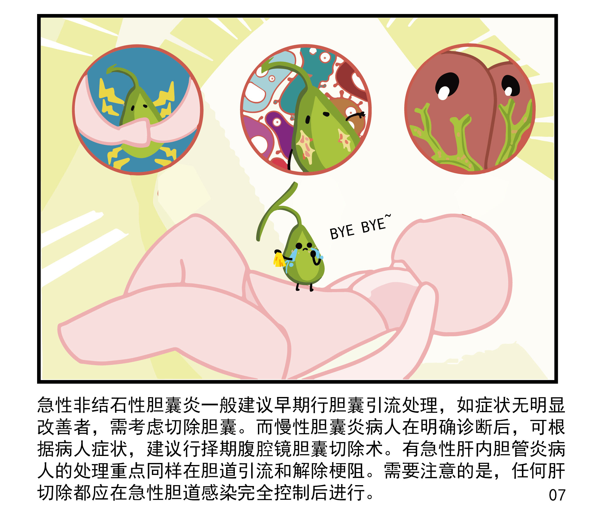 胆囊结石的并发症:胆道感染_胆道感染_发病原因_症状表现_治疗方式