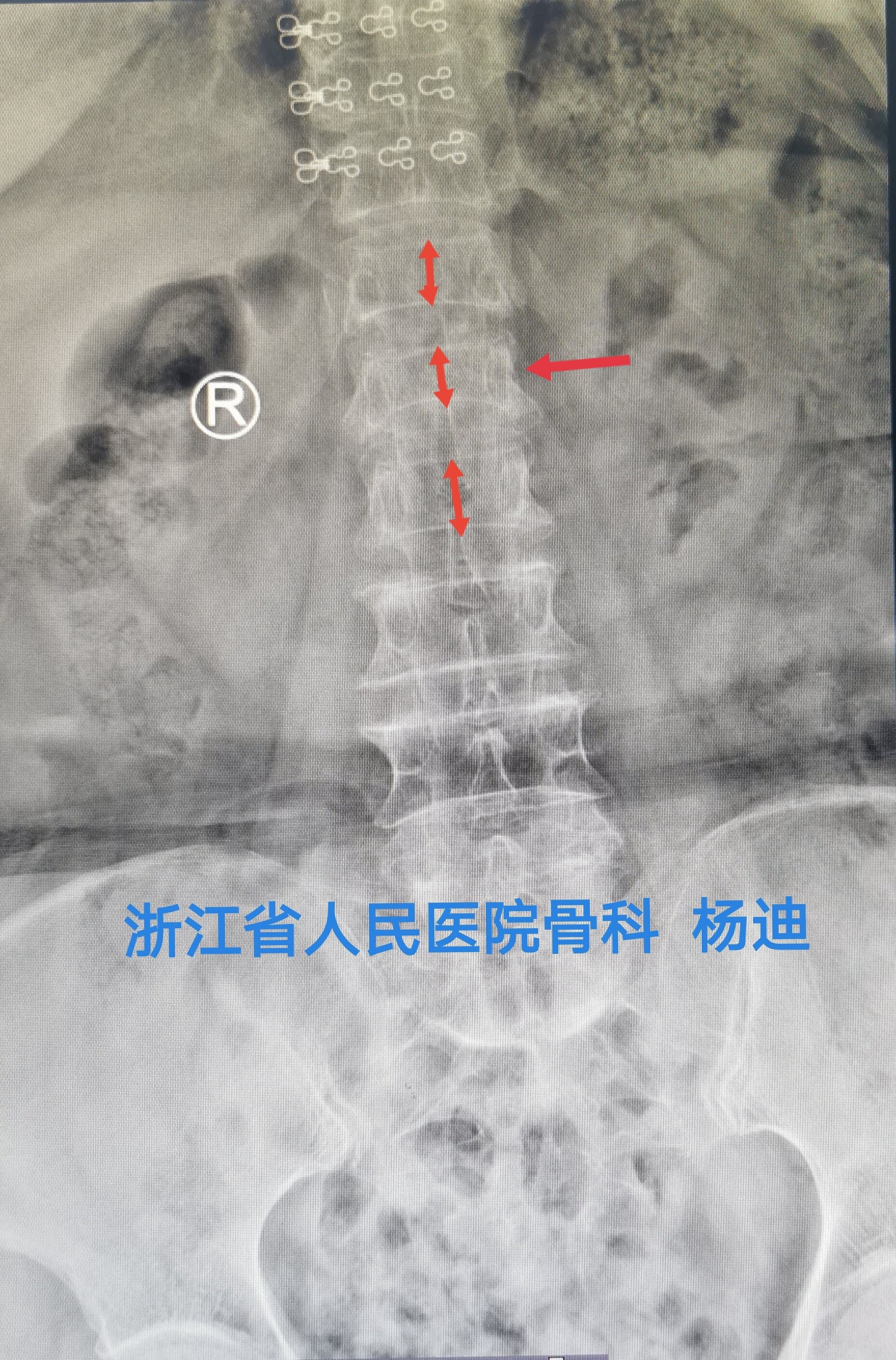 腰椎磁共振t1相:箭頭所示為腰1椎體信號改變,提示腰1骨折.