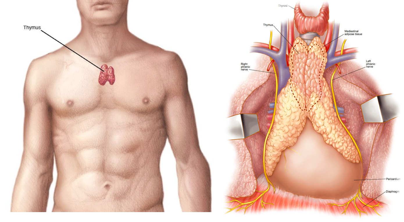 肌無力科普系列之七:手術為什麼能治好重症肌無力?