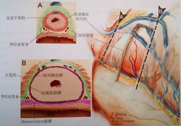 性神经血管束的解剖示意图而保留性神经的前列腺癌根治术通过仔细解剖