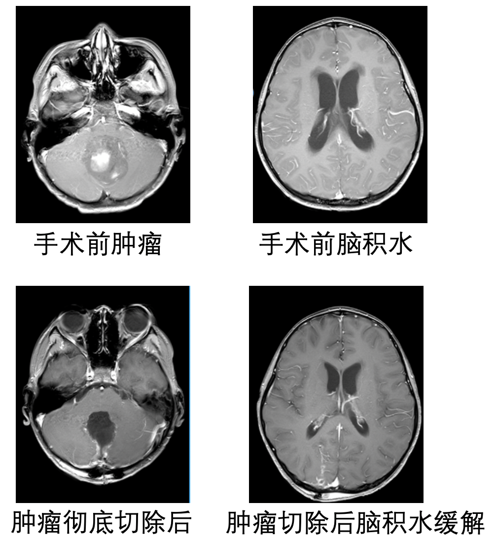 髓母細胞瘤引起的腦積水需要治療嗎