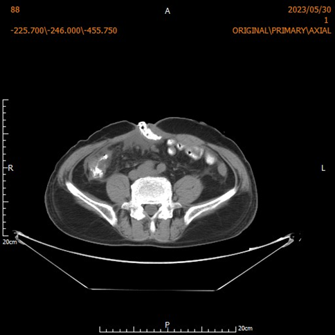腹腔感染的诊断 0oYBAGX5UluAZWUGAAHHkFb5cKE127.png?_ms_=724b