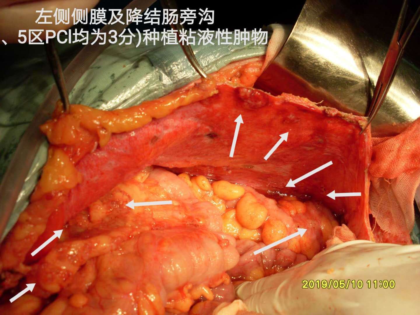 病例59闌尾源性高級別pmp累及宮頸卵巢之治療