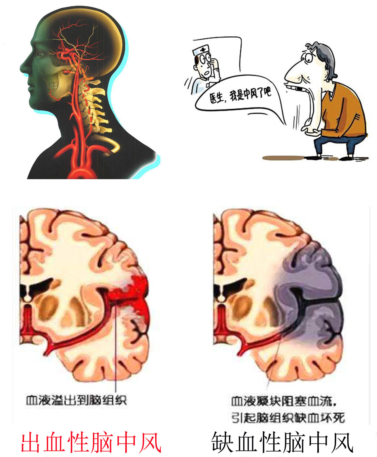 (福建协和医院神经外科涂献坤博士讲述烟雾病知识系列一)_烟雾病_症状