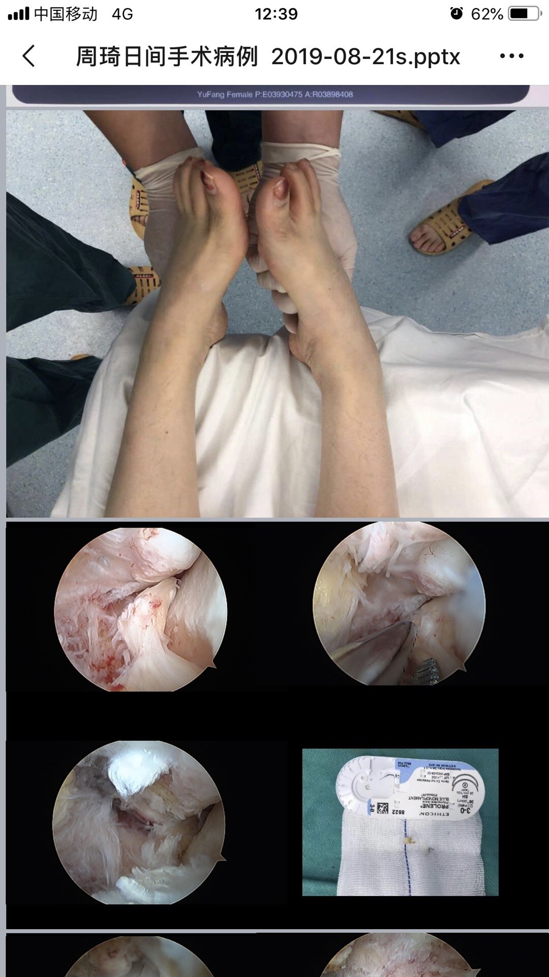 严重崴脚关节镜治疗微创可靠 韧带损伤 韧带损伤治疗方法 好大夫在线