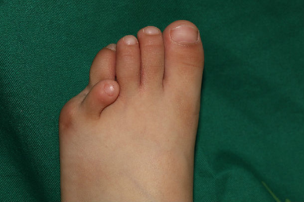 脚趾畸形矫正系列.婴儿重叠趾,脚趾畸形可以整形吗