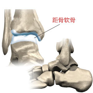 距骨骨软骨损伤怎么一回事(一)