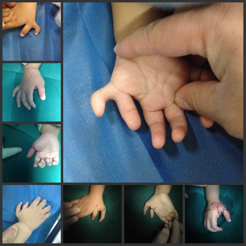 治疗多指需要注意哪些_多指畸形_多指畸形