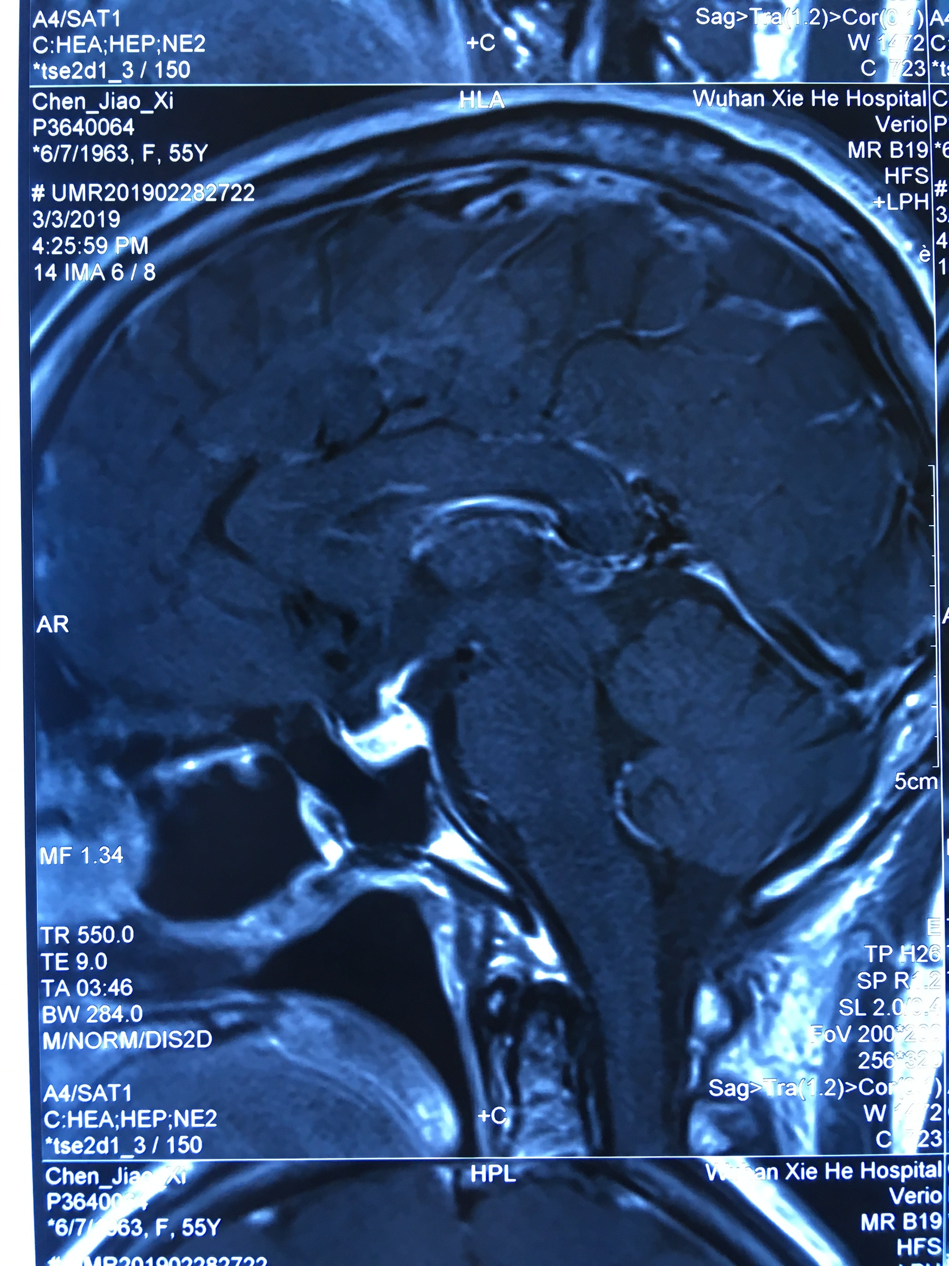 脑垂体微腺瘤图片
