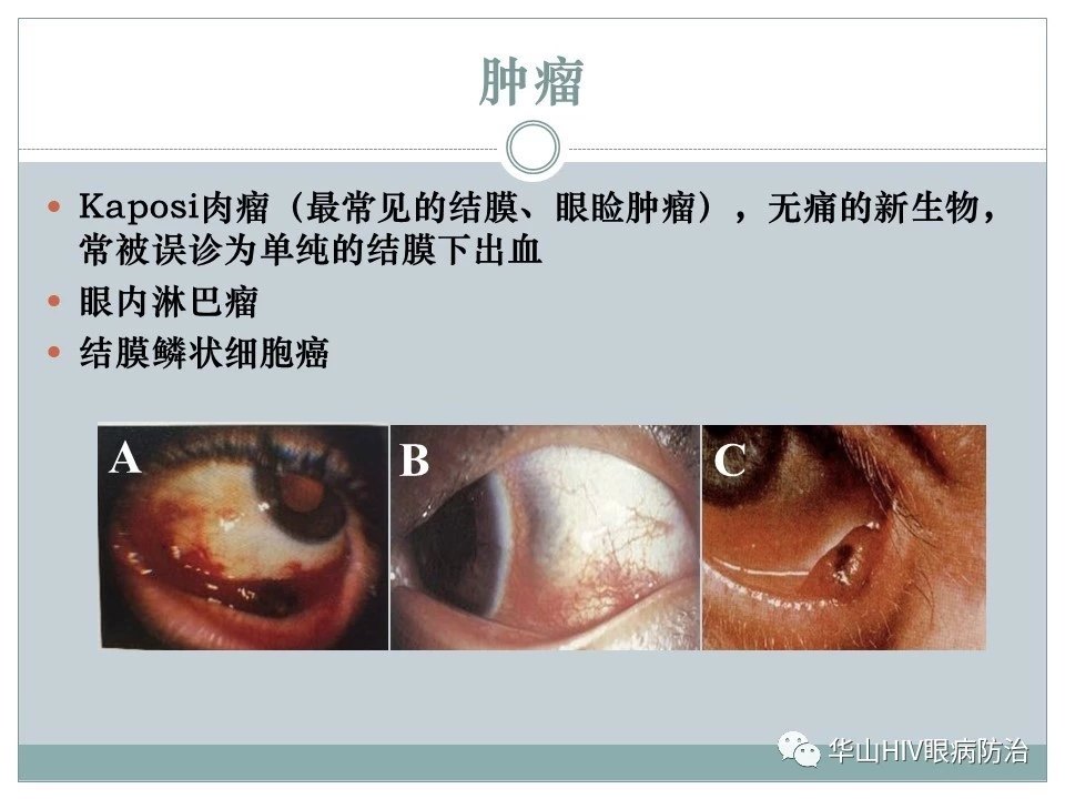 艾滋病的眼部早期症状图片