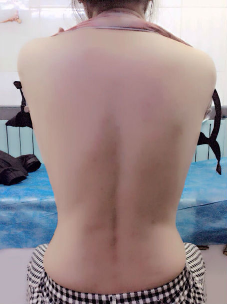 颈椎病导致上肢无力疼痛呼吸困难,祖传手法2周