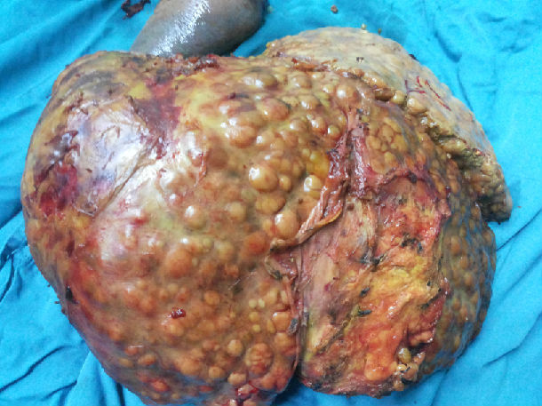 肝癌肝切除后肿瘤复发的肝移植手术治疗 