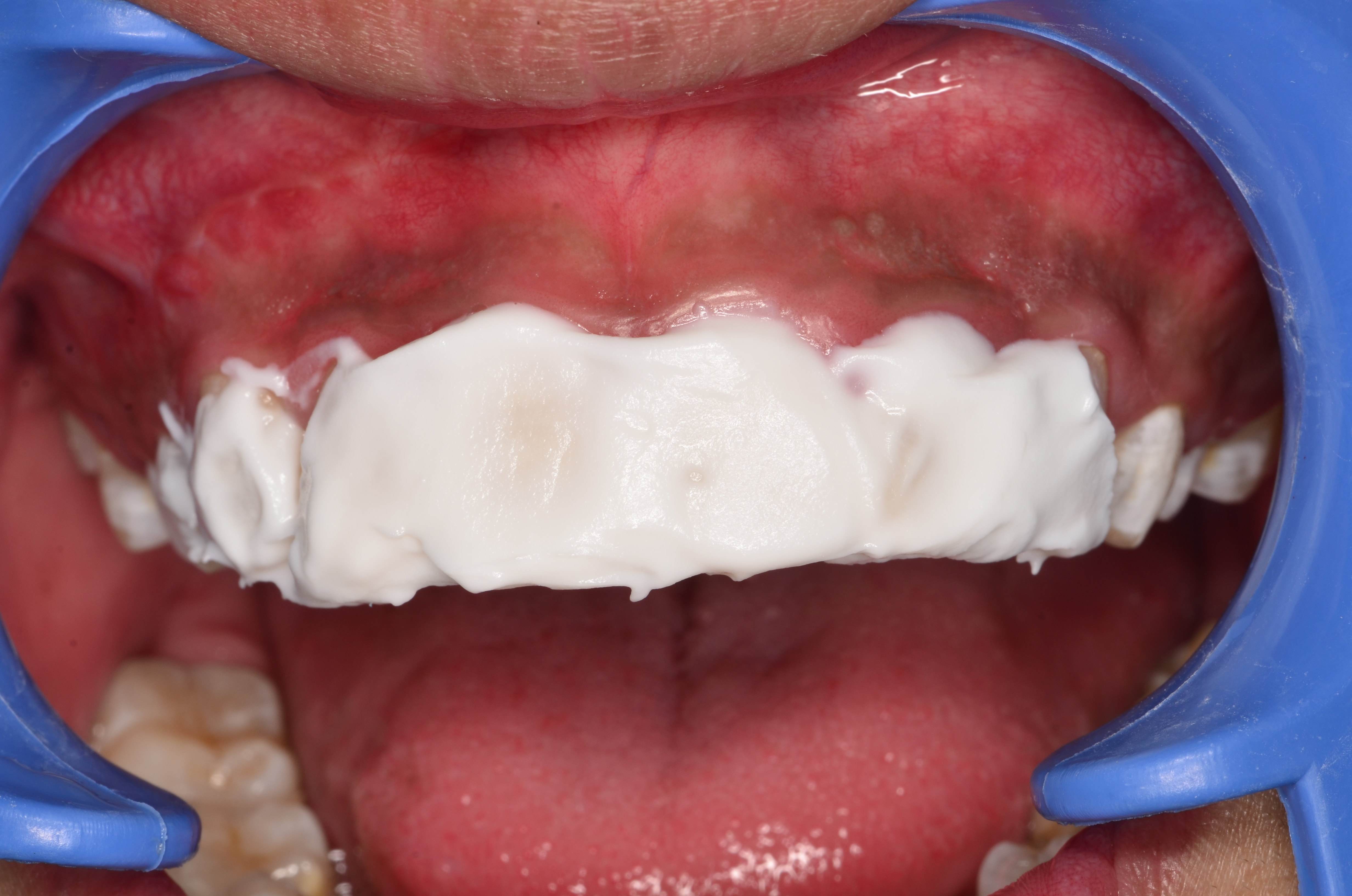 氟斑牙漂白治疗三年随访一例