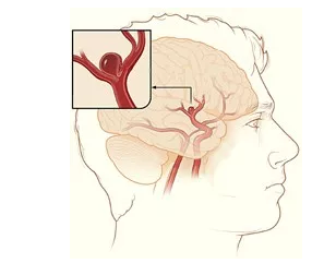 说好不破,夹层还是破了(二)——颅内动脉夹层的治疗和预防_脑动脉瘤