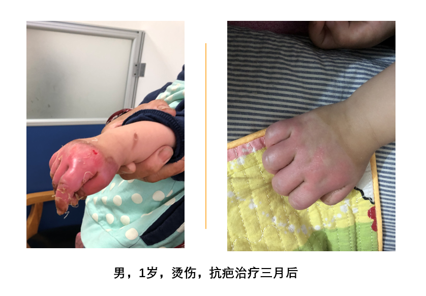 各种小伤口愈合后三个月,能恢复到什么程度 - 好大夫在线