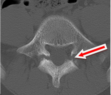 典型病例:腰椎峡部裂