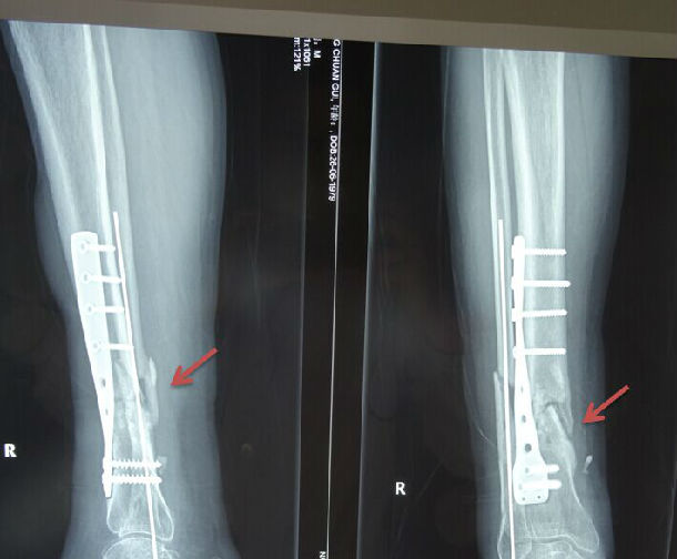 胫骨骨折术后骨髓炎治愈病例 好大夫在线