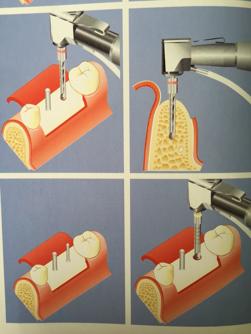 種植牙一般步驟一期種植部分