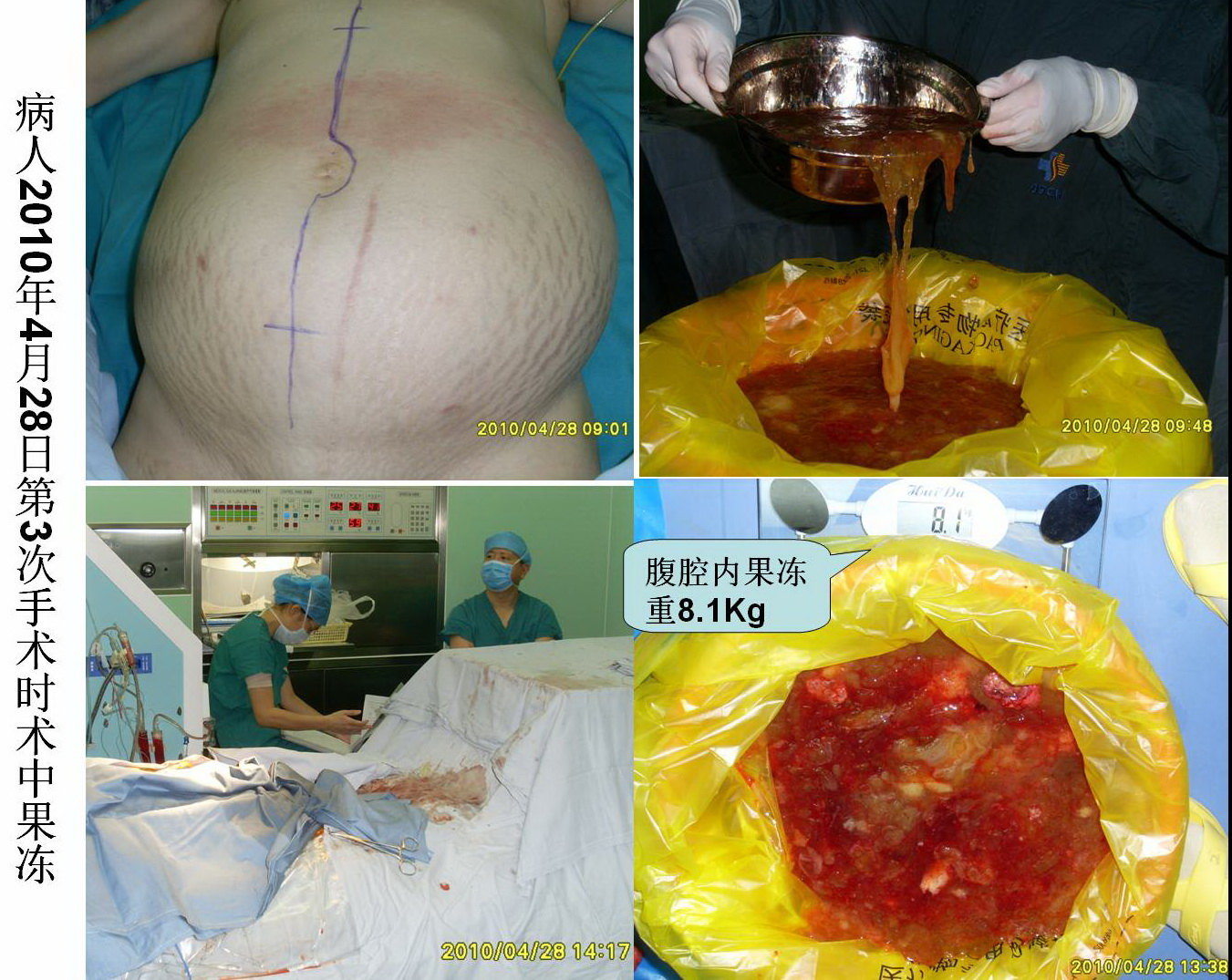 腹膜假黏液瘤病例(10)--我们要有信心与瘤共舞! - 好大夫在线