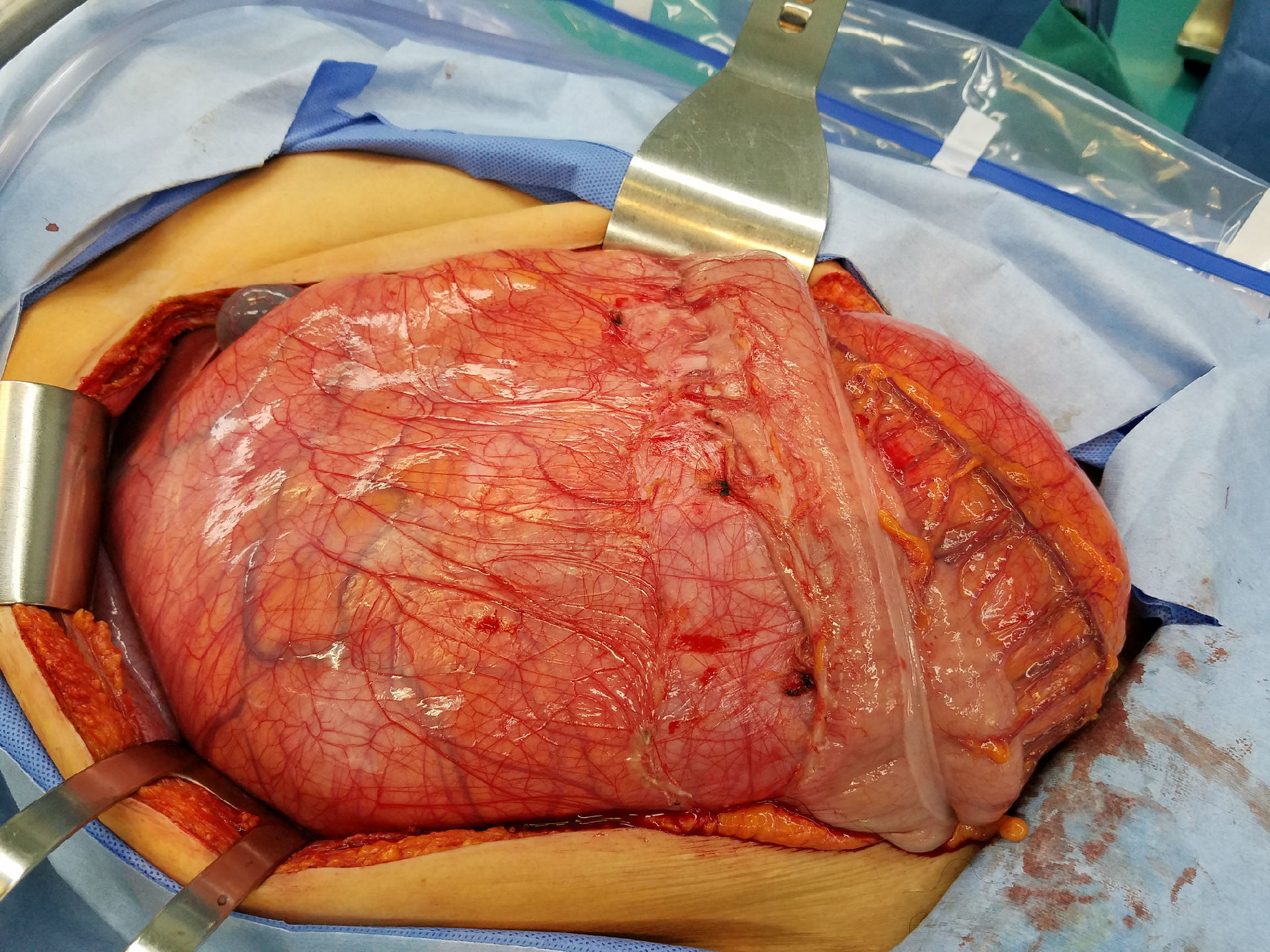 腹部肿瘤图片