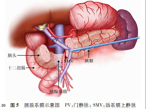 淺談胰十二指腸切除術的手術技巧 (原創)