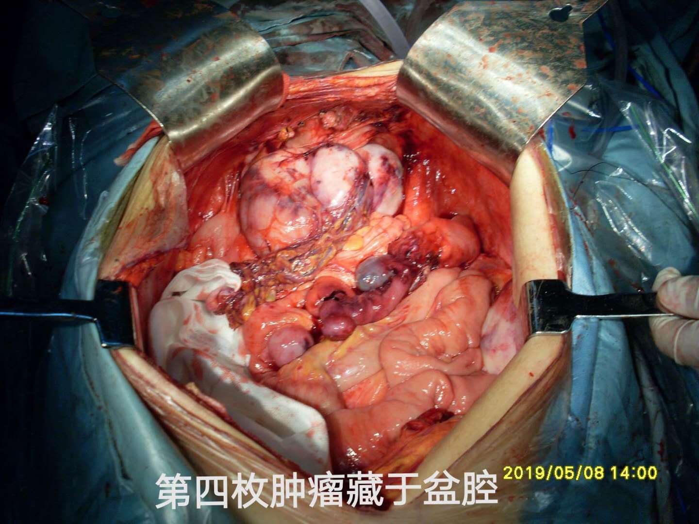 腹部肌肉瘤症状图片图片