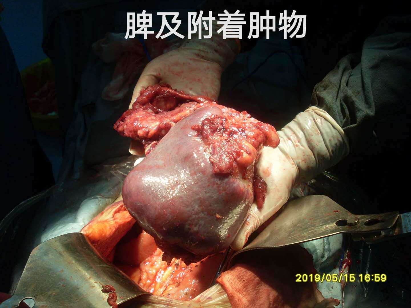 病例63--阑尾pmp巨大卵巢粘液囊肿挤占腹腔致高腹压 - 好大夫在线