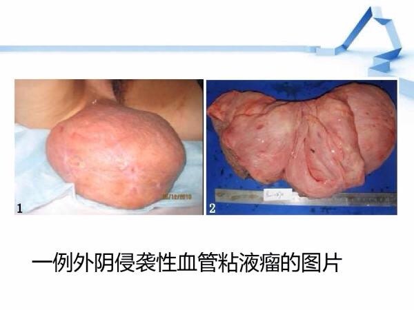 侵袭性血管粘液瘤 - 好大夫在线
