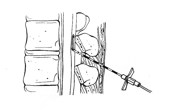 后面观骶裂孔和骶角是髓管穿刺的重要解剖标志,其定位方法是:先摸清