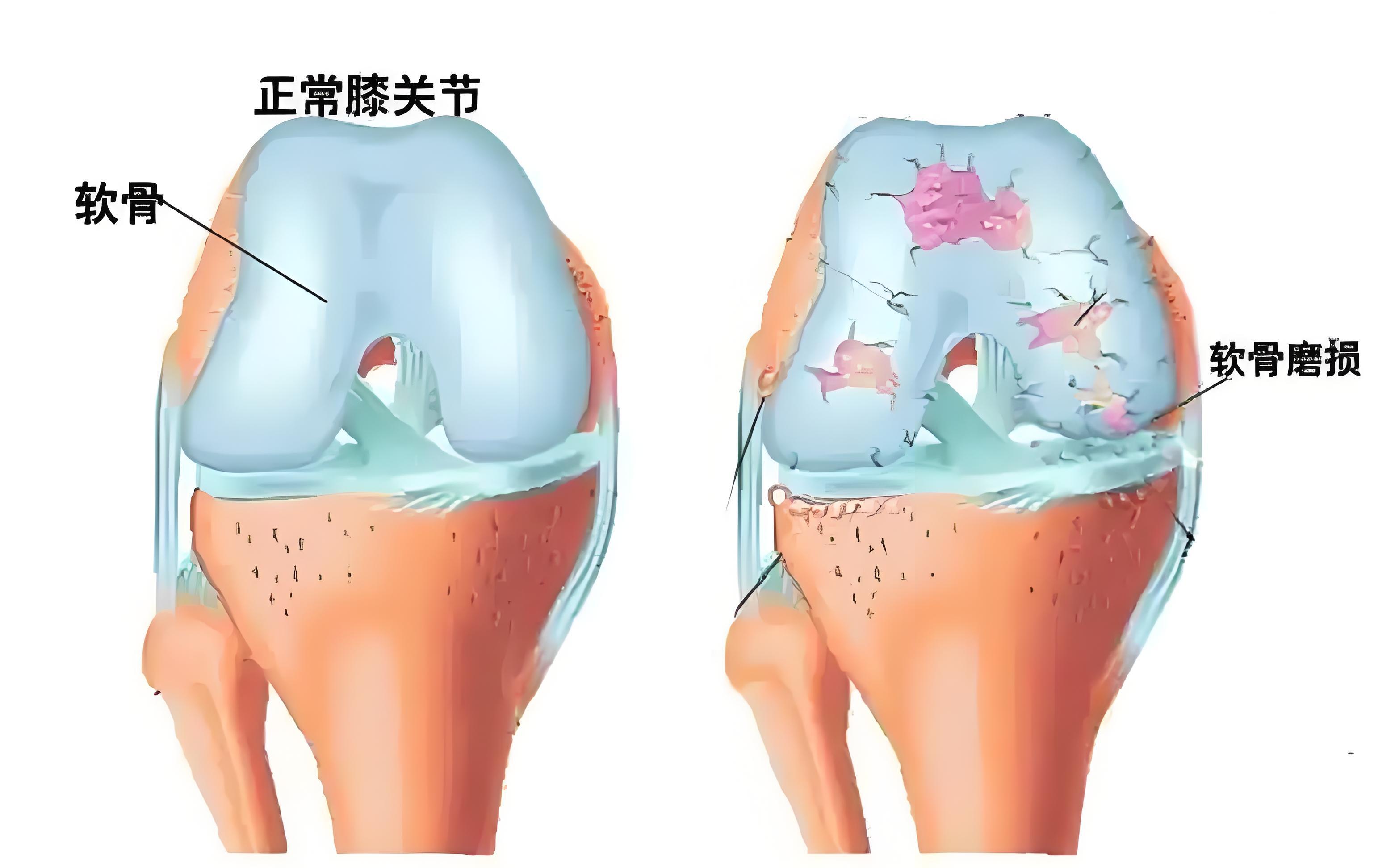髌骨软化症,顾名思义,就是髌骨(膝盖骨)的软骨出现了问题