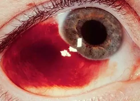 眼睑结膜裂伤图片