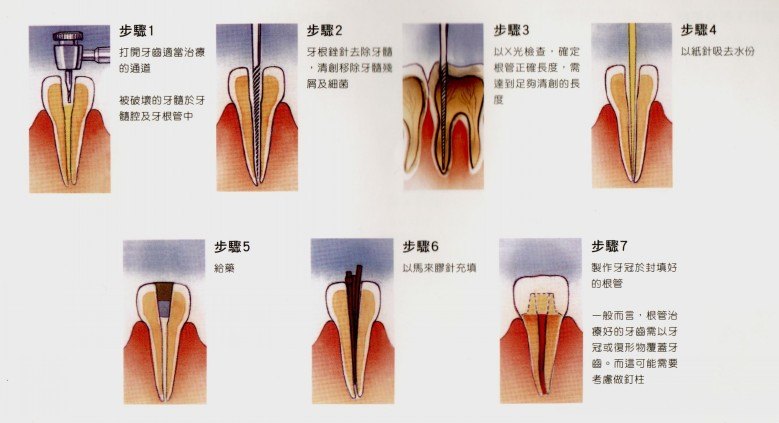 乳牙开髓位置3d图图片