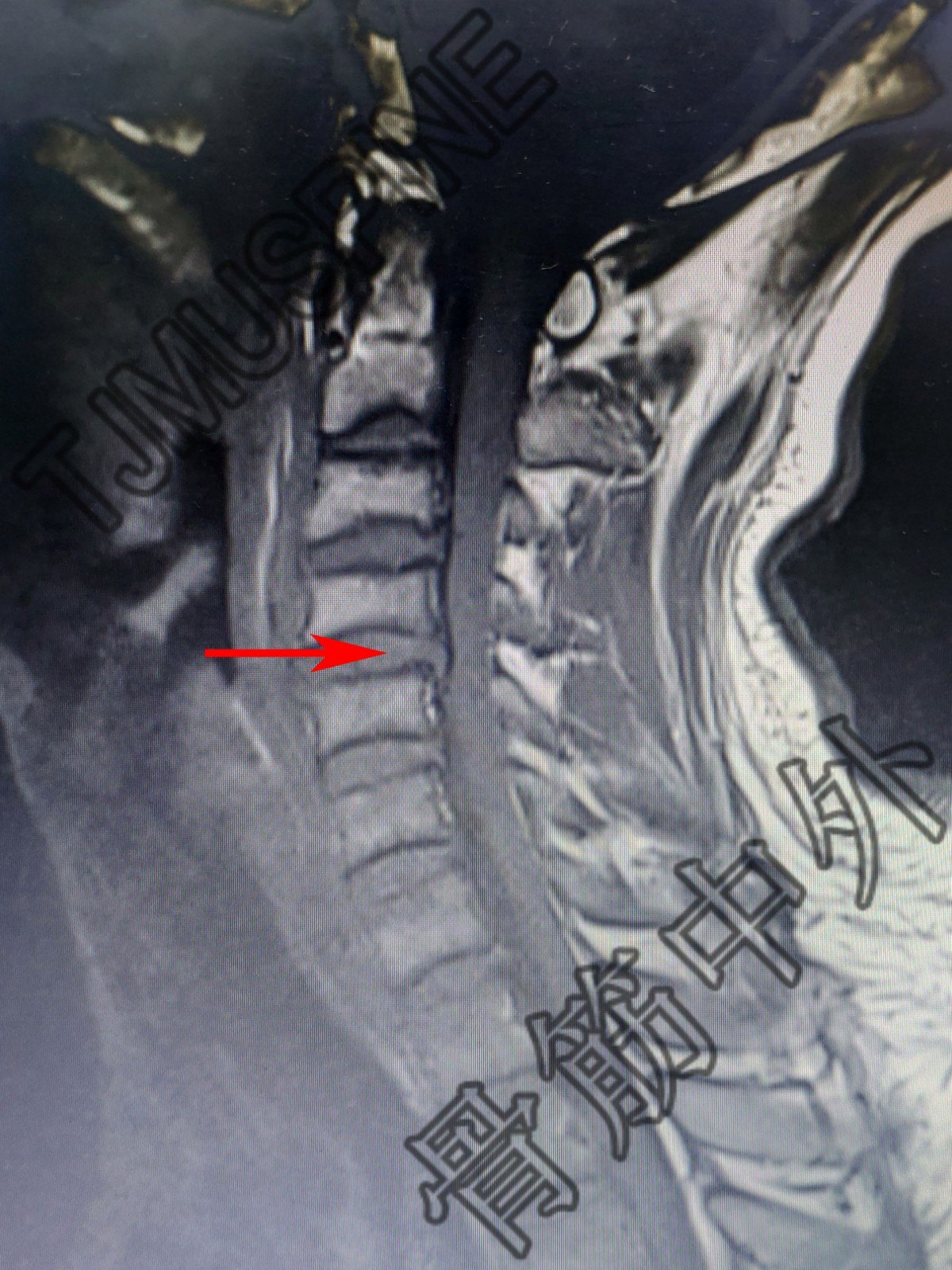 术前mri术前颈椎ct
