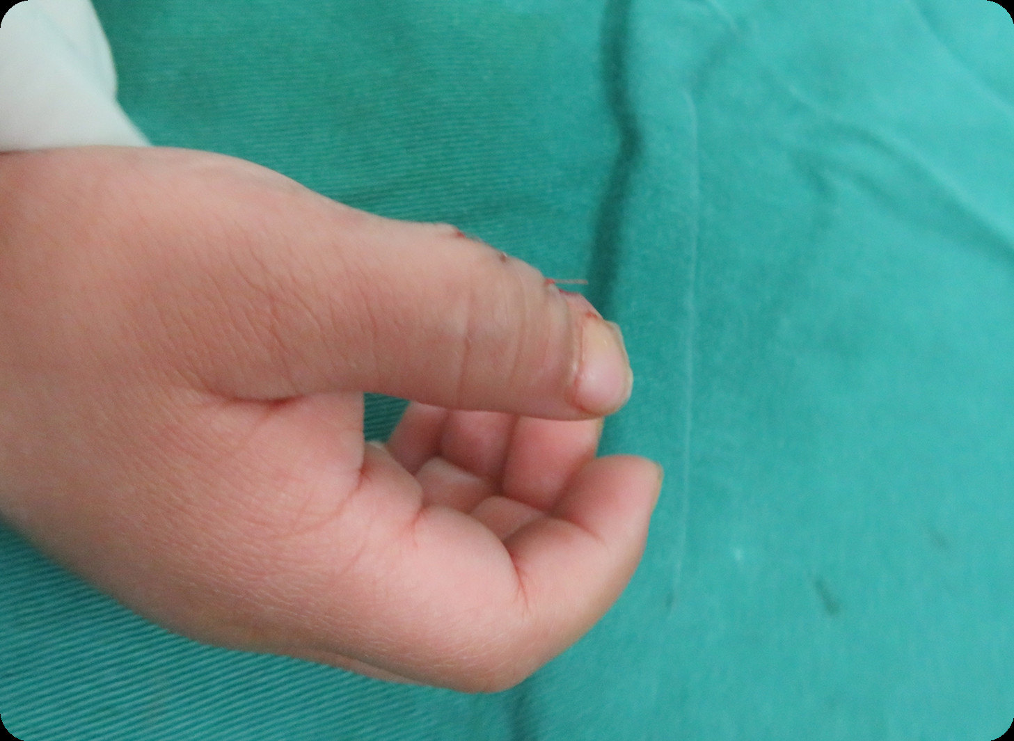 宝宝生下来有并指怎么办?_并指畸形_手术_治疗方式 - 好大夫在线