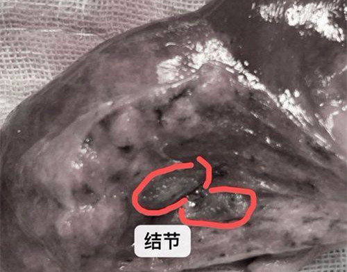 肺结节怎么治疗 肺结节怎么治疗