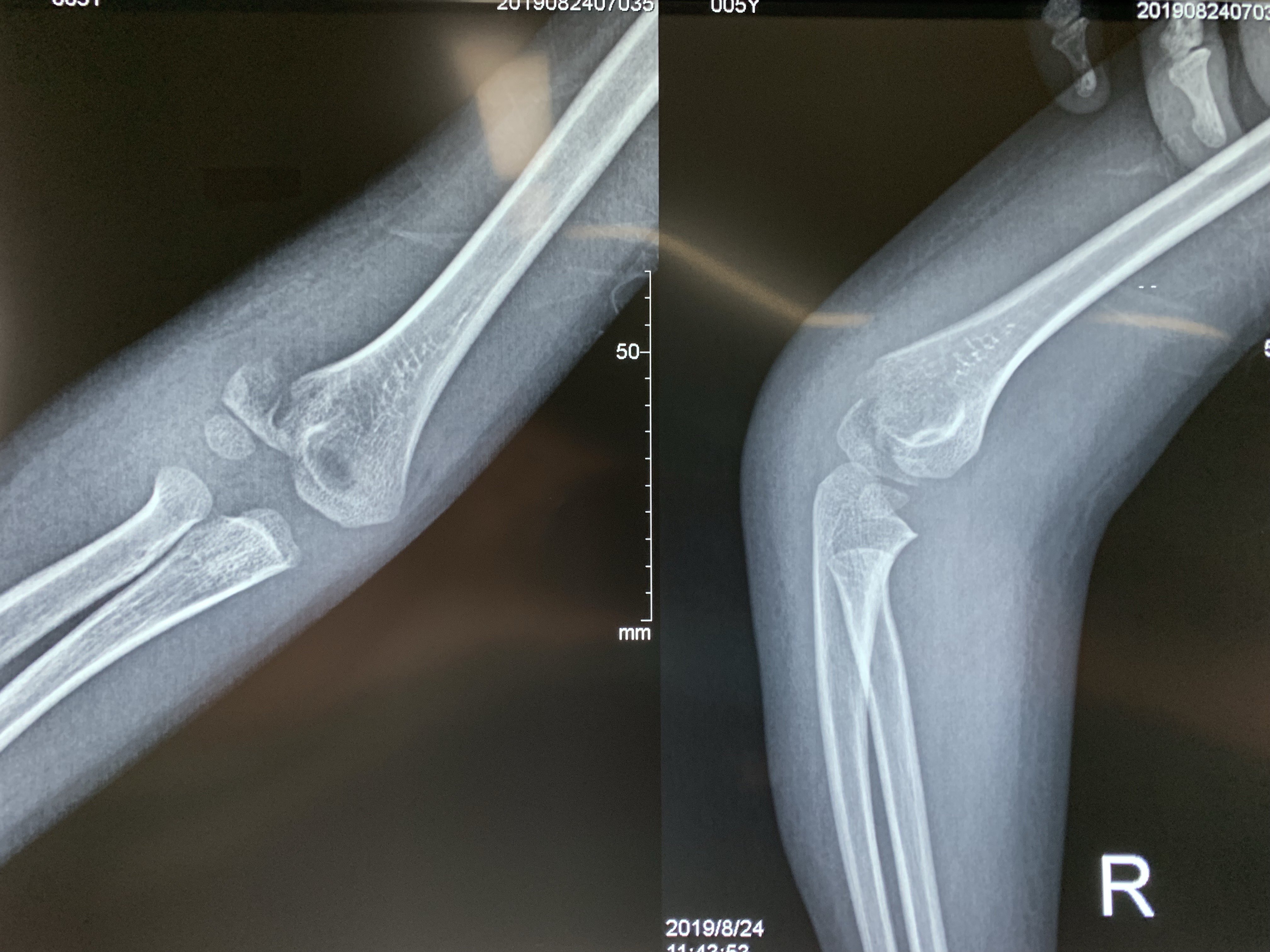 肱骨外髁骨折 m.haodf.com