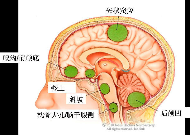 脑膜瘤示意图图片