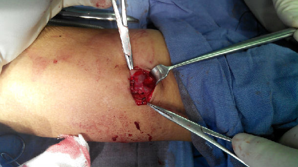 浅谈血液透析通路系列之一:肘部自体动静脉内瘘 - 好大夫在线