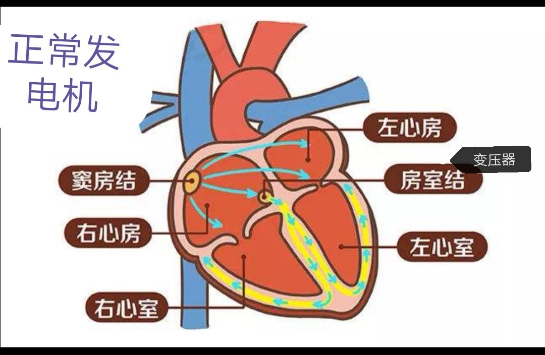 正常心脏"发电机"窦房结,也是心脏"司令部",指挥心脏协调跳动,窦房结