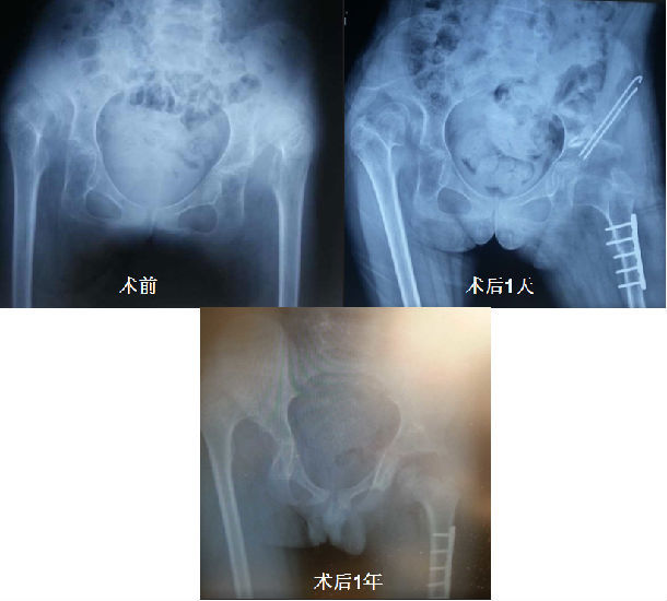 該患兒家地處偏僻,術後2年才來聯繫取出鋼針及鋼板,x片示患兒股骨頭