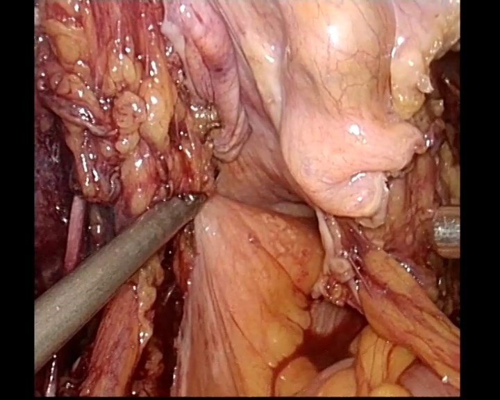 乳糜色腹腔积液图片图片