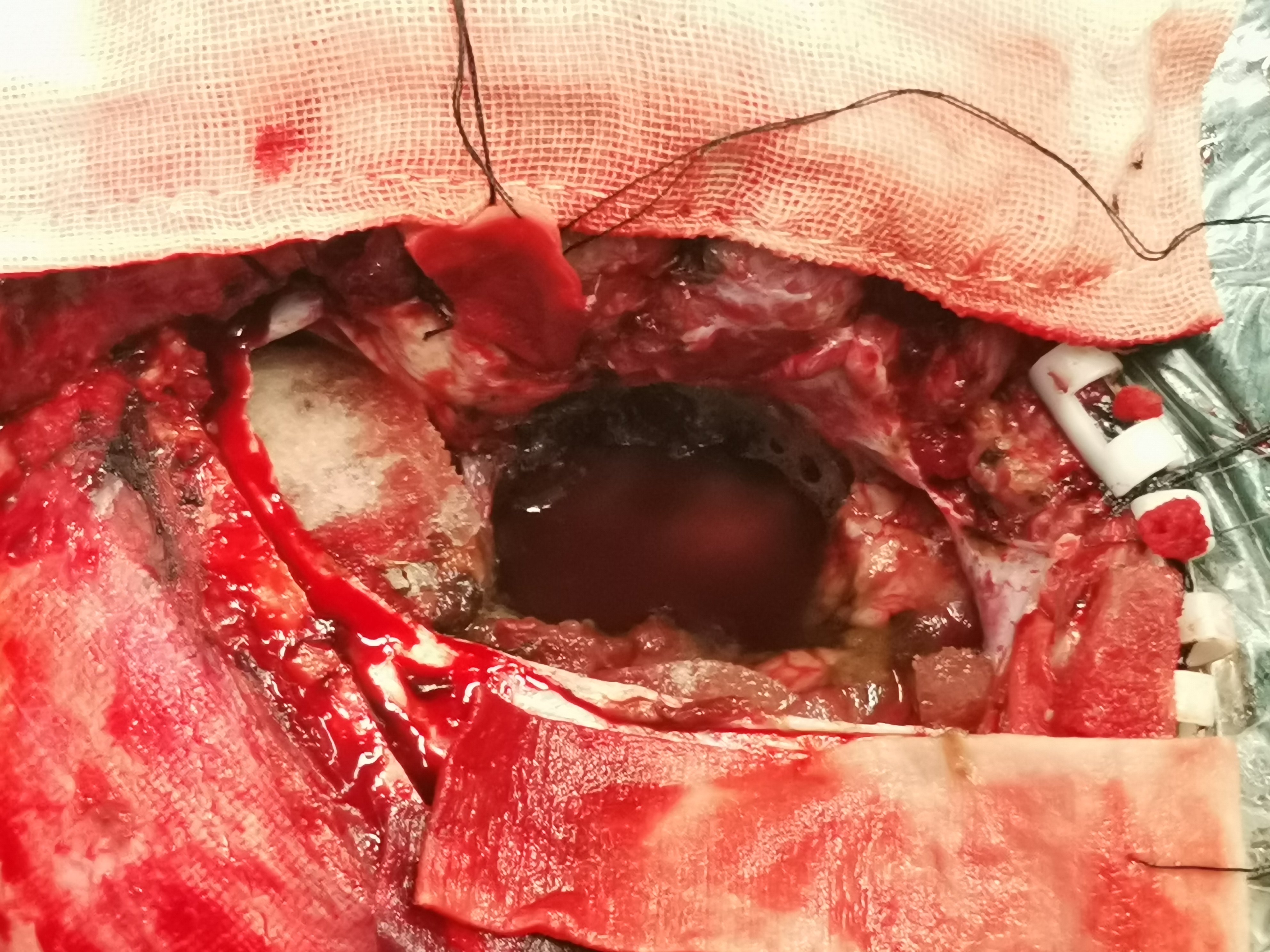 一例巨大颅中窝脑膜瘤回顾 - 好大夫在线