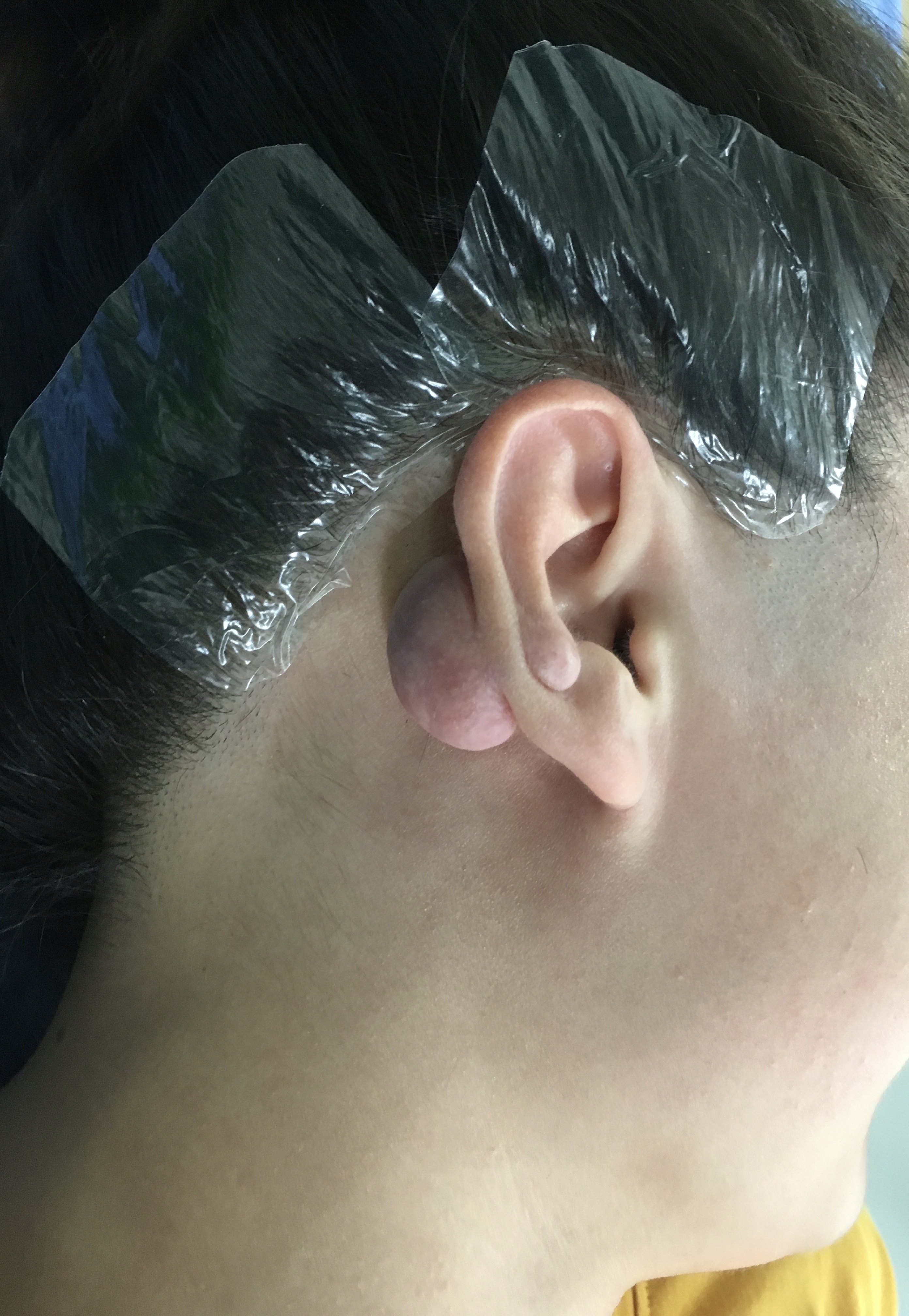 耳部瘢痕疙瘩图片图片