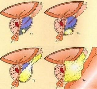 前列腺癌症状图片图片