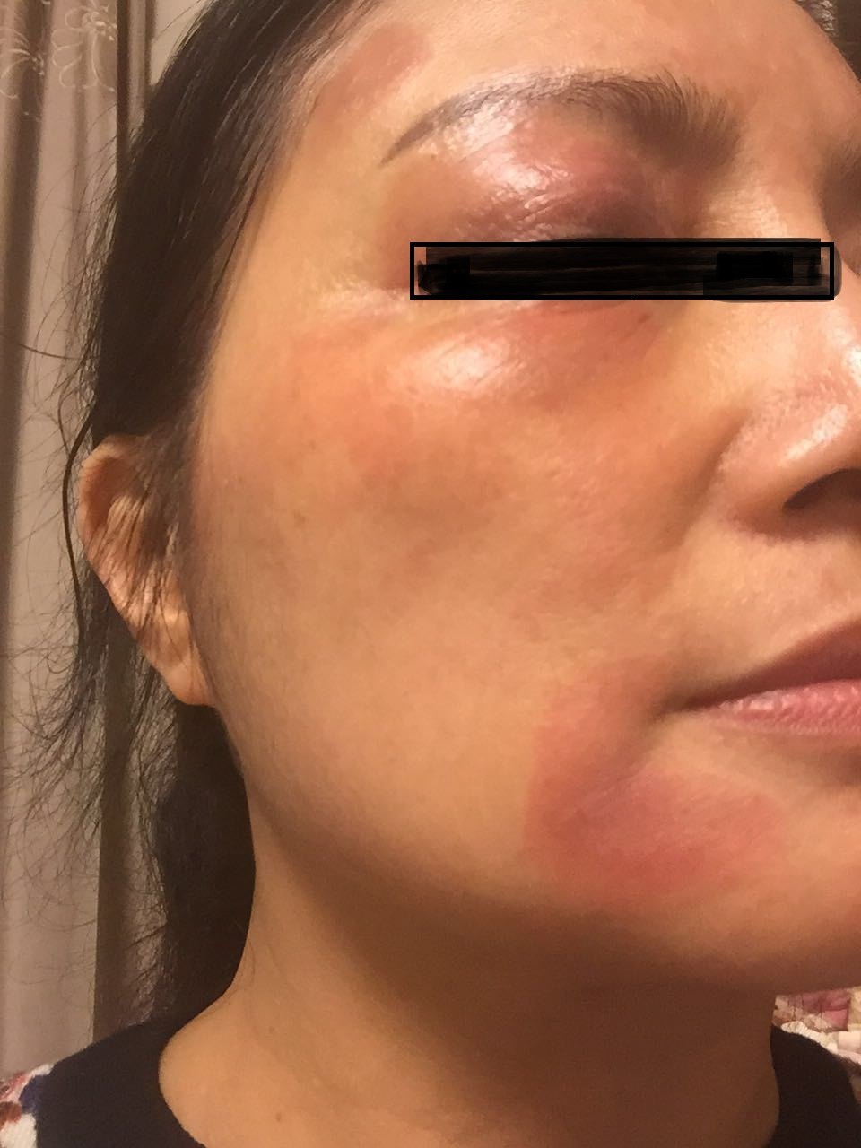 嘴唇边上的皮疹特别顽固,但是瘙痒明显好转,治疗1周后开始脱皮.