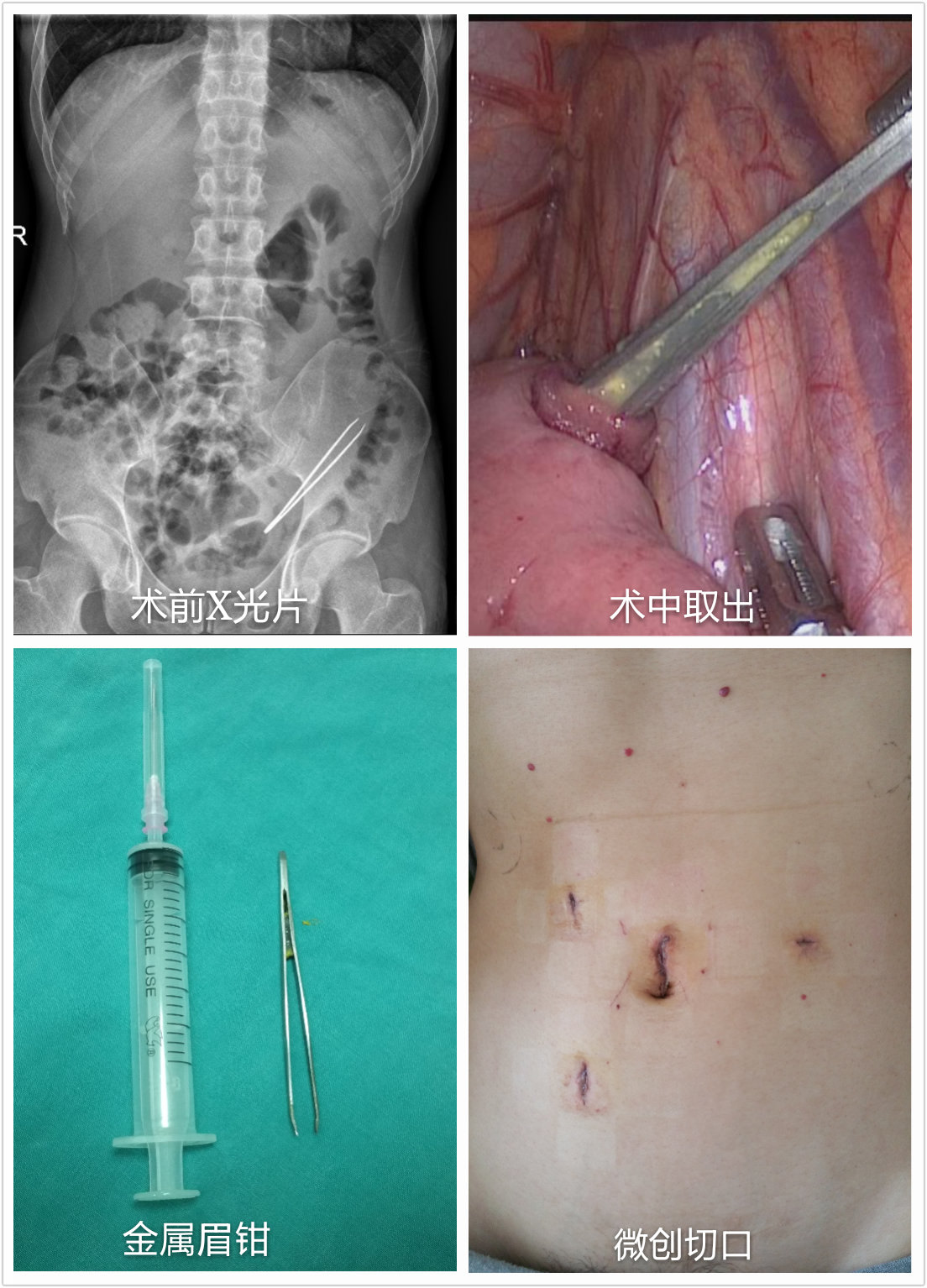 複雜性肛瘻術前術後比較重度直腸脫垂手術術前術後比較重度混合痔術前