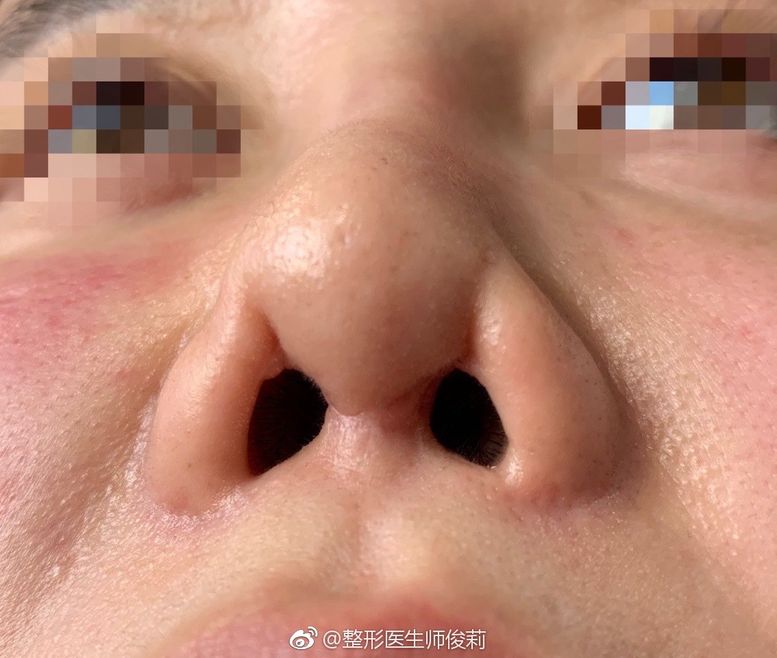 鼻子挛缩图片 前期图片