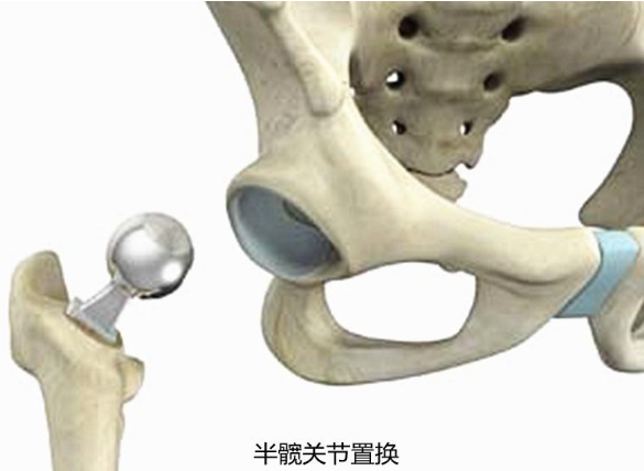 送髋和不送髋的图对比图片