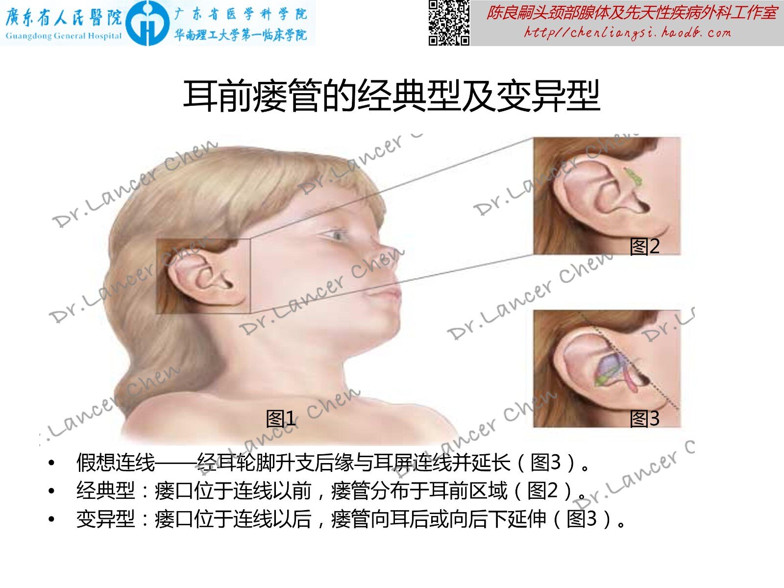 医学科普 耳前瘘管的b面 变异型 先天性耳前瘘管 先天性耳前瘘管